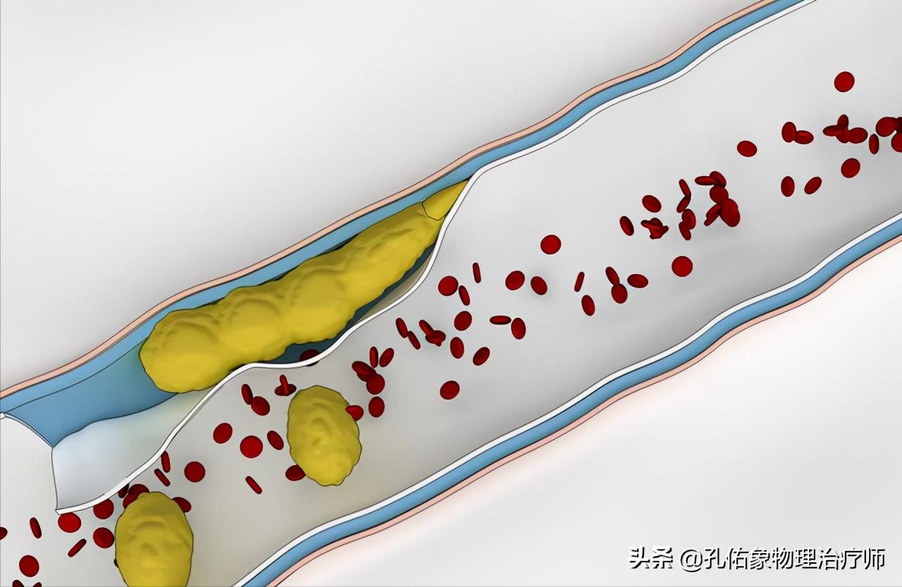 中老年人血脂高有什么危害,中老年人血脂高怎么治疗