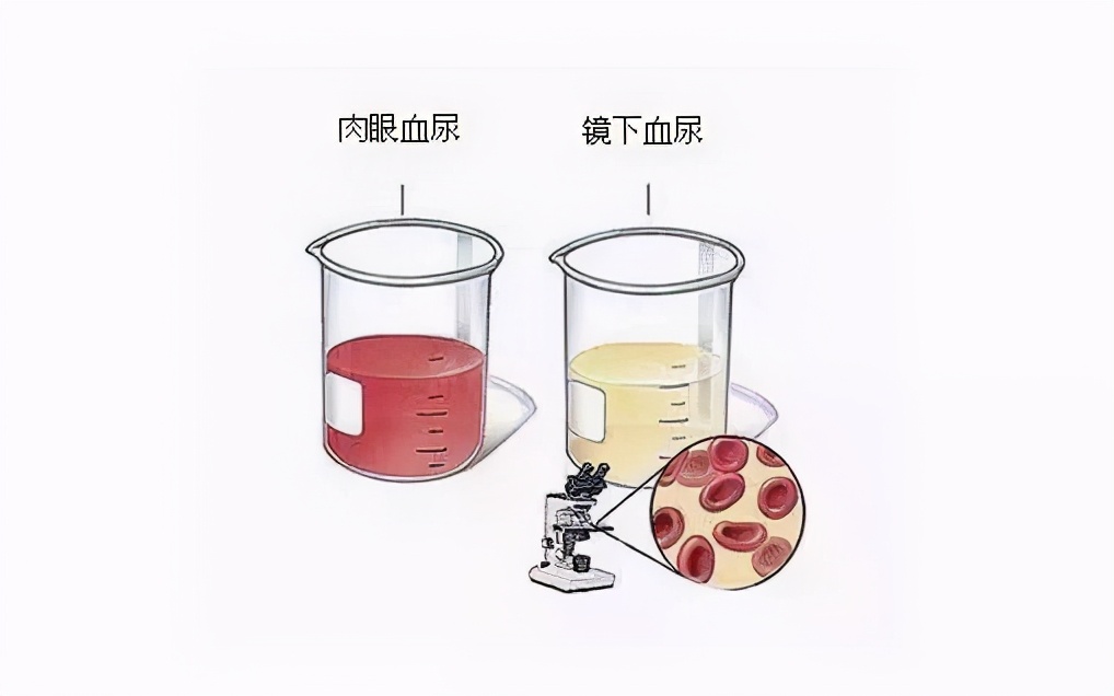 尿酸高急性肾衰竭,慢性肾衰竭尿酸高