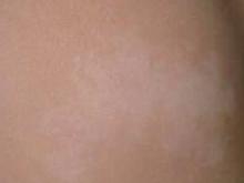 宝宝身上有不光滑胎记,宝宝身上胎记不哭就没有