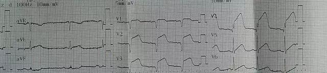 32岁北大博士心梗猝死,知名医生突发心梗