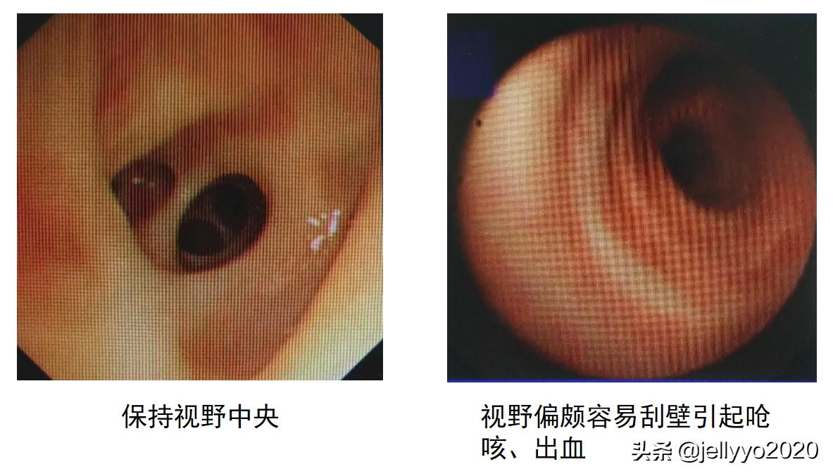 支气管镜细针操作视频及讲解,气管镜的正确手法图解