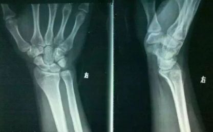 健身时关节有异响还能继续运动吗,训练时关节为什么会响