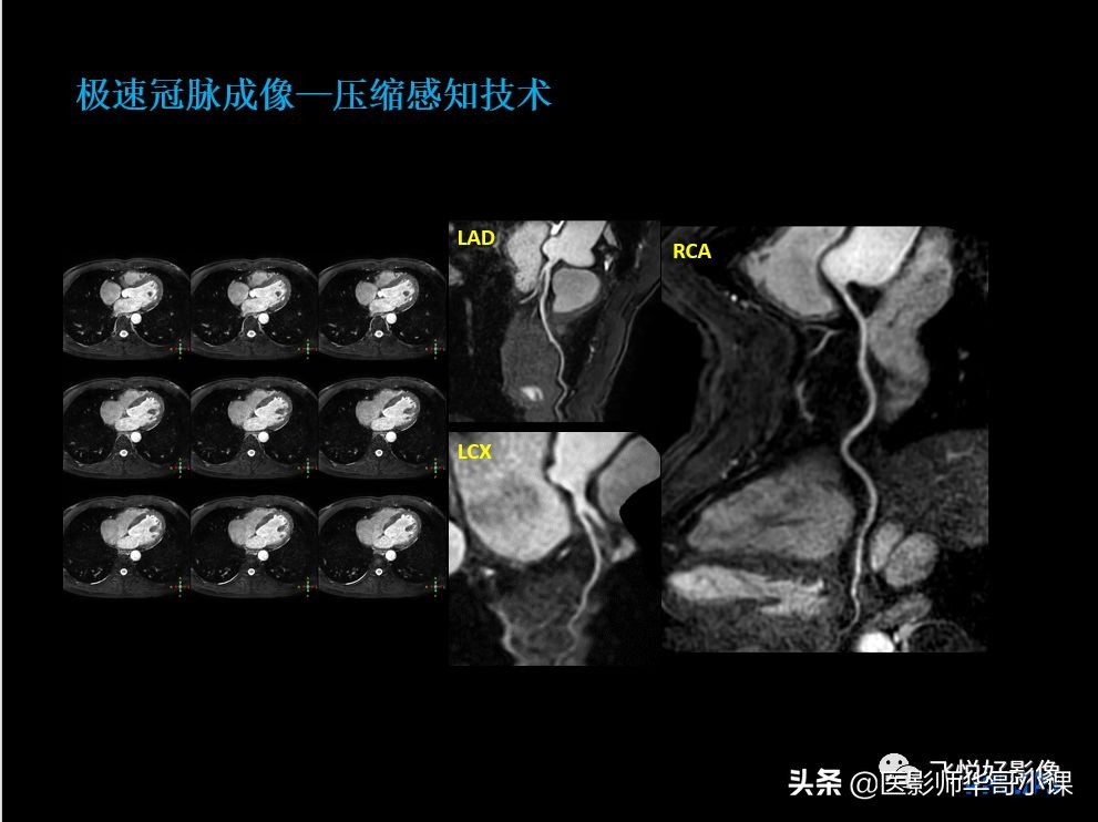 飞利浦核磁共振快速扫描,飞利浦磁共振心脏扫描