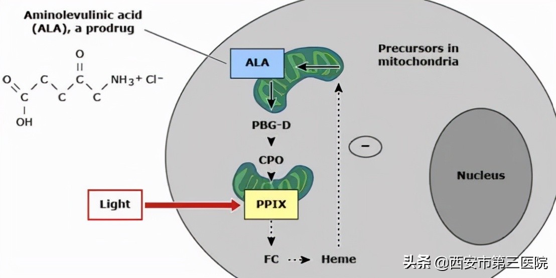 皮肤科红光治疗的适应症,光动力治疗疣原理