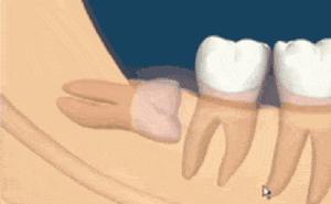 智齿出现这几种情况不拔不行,智齿出现什么情况疼不疼都要拔