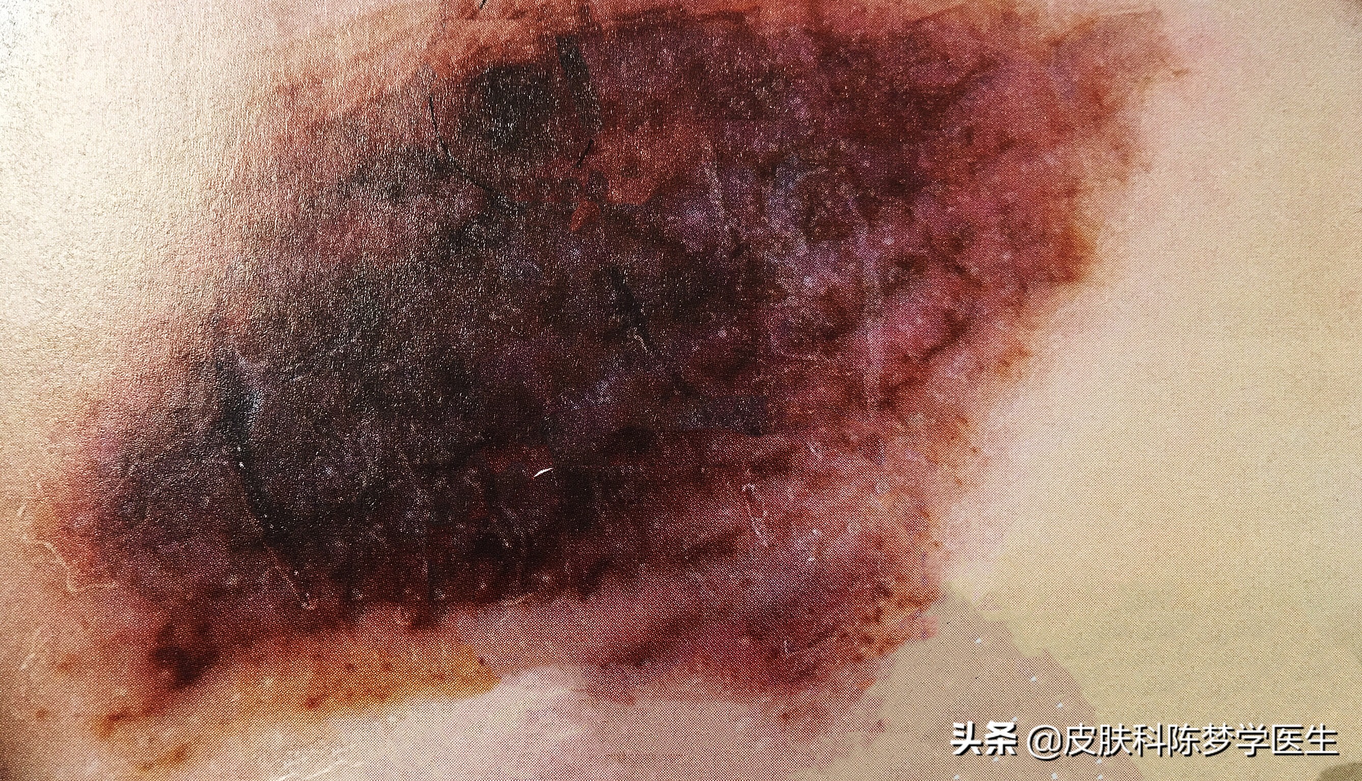 激光点痣真的会导致痣发生癌变吗,脸上有痣能激光点痣吗