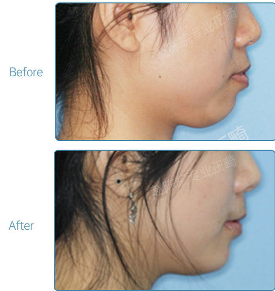 杭州口腔医院整牙,杭州整牙医生怎么选