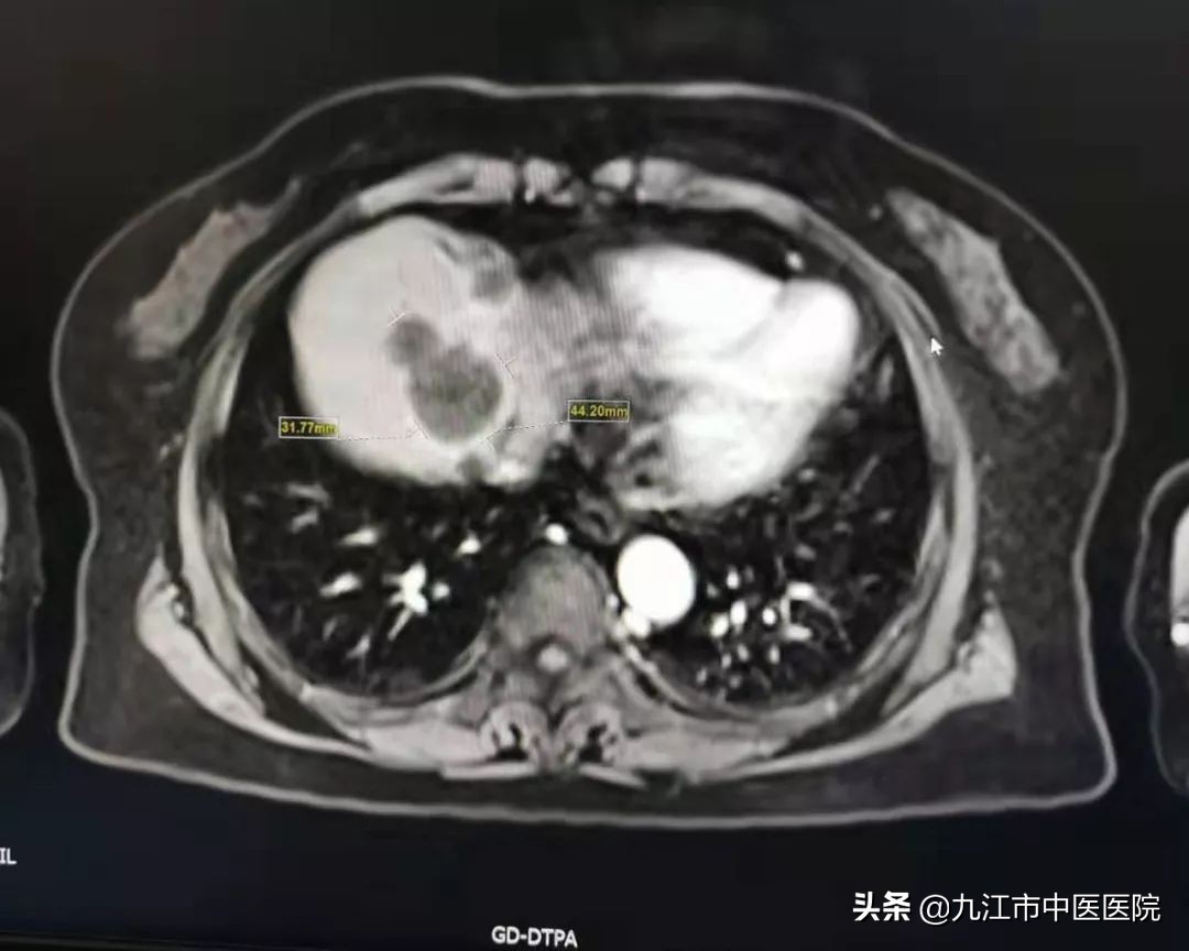 胰腺癌晚期中药治疗带瘤生存奇迹,胰腺癌中医治疗生存期