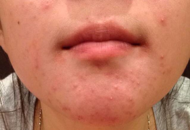 痘痘长在不同部位说明什么原因,痘痘长在各个身体部位的原因