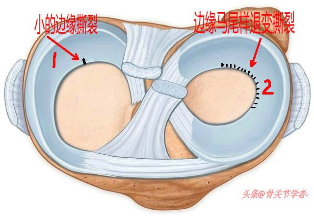 磁共振怎么看半月板损伤程度,磁共振半月板损伤1级是什么