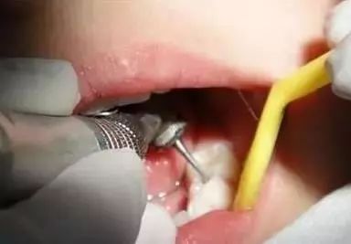 人人都说洗牙好，那补完牙可以洗牙吗？