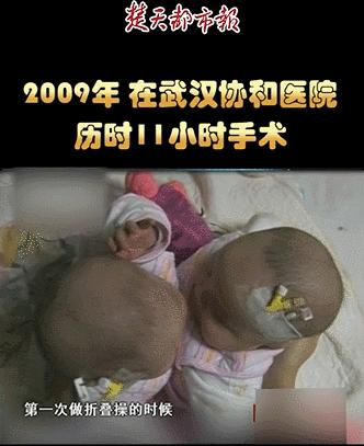 坐骨连体女婴现在状况,坐骨连体姐妹分离成功了吗