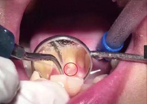 拔智齿疼还是智齿发炎疼,智齿疼可以拔智齿吗