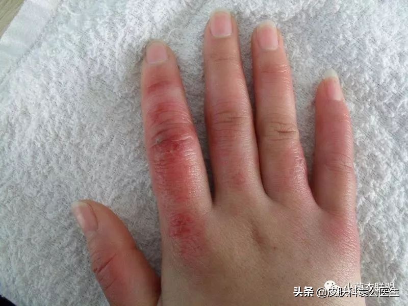 冻伤后痒痒是怎么回事,冻伤瘙痒