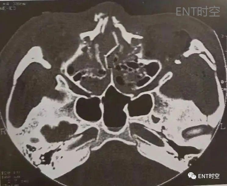 医学影像学解剖鼻骨,医学影像骨折