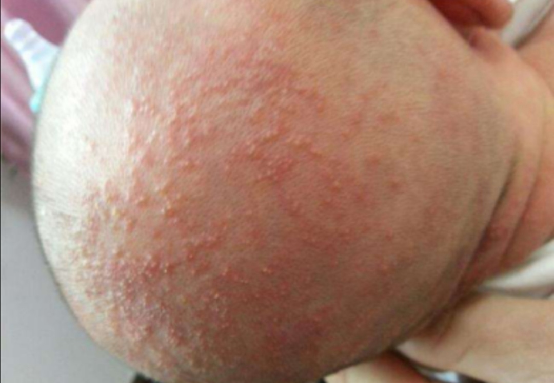 儿童湿疹常见的三大原因,家长要如何护理湿疹宝宝比较好