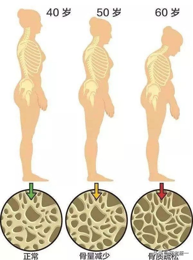 50岁严重的骨质疏松怎么办,女性50岁补钙什么牌子最好