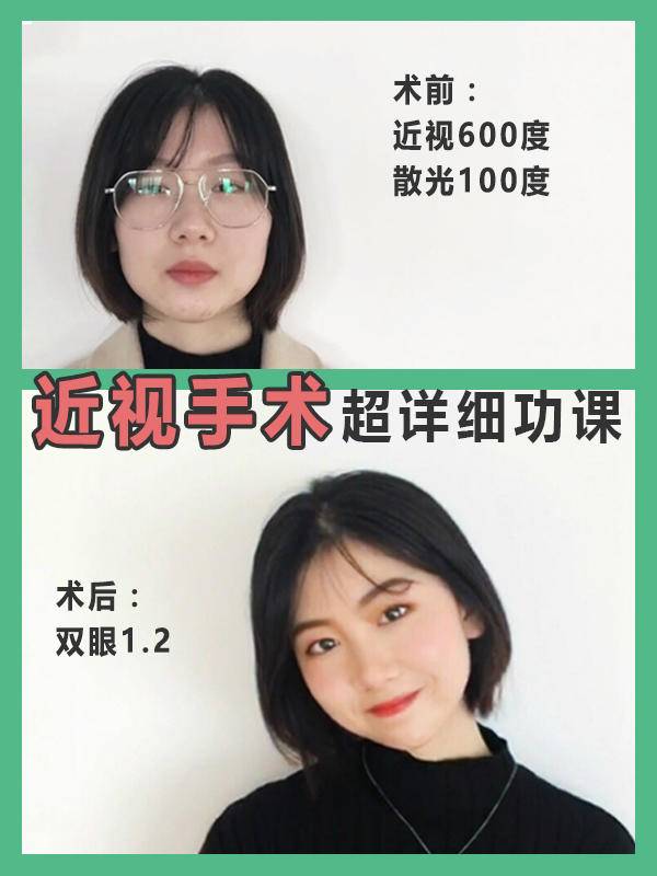 近视手术真实案例分享博主,近视屈光手术亲身经验