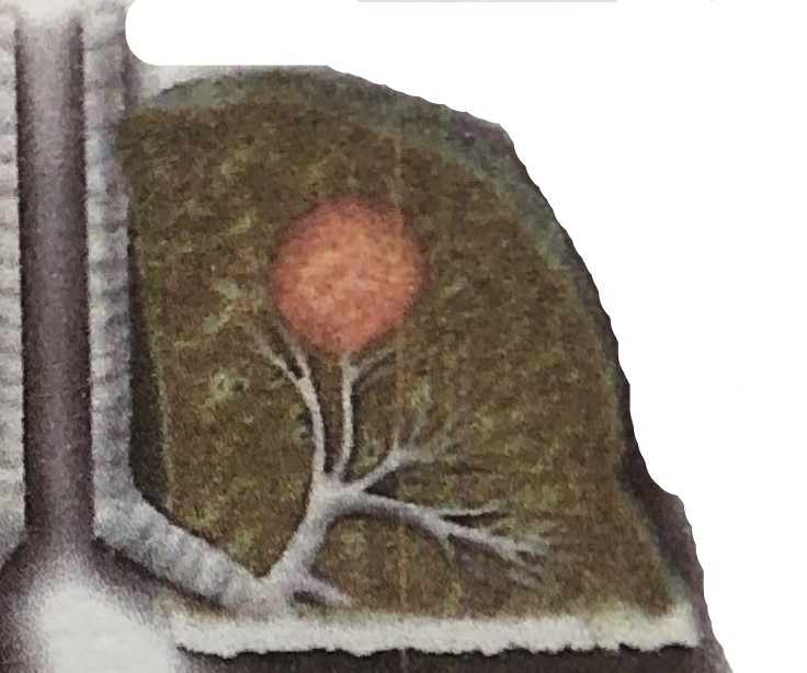 怎样判断非小细胞肺癌早中晚期,做气管镜能查出肺癌早中晚期吗