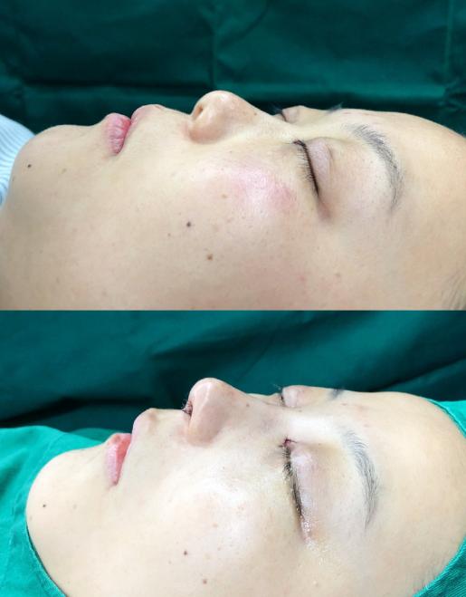 五官扁平的大饼脸,大饼脸和扁平五官怎样自救