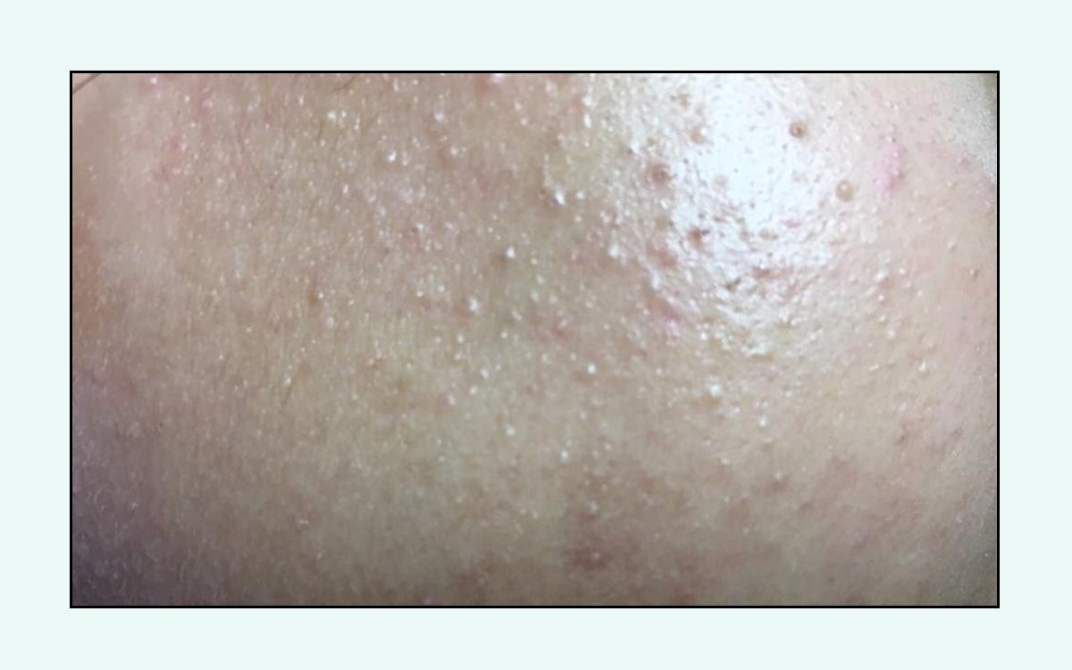 脸上的红疙瘩疼是什么原因,脸上的各种疙瘩