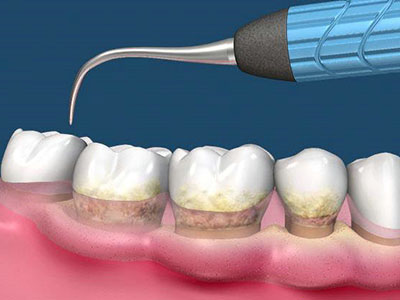 洗牙多长时间洗一回,洗牙多长时间洗一次牙垢