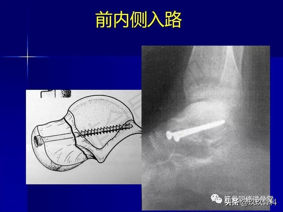 距骨骨折后遗症,距骨骨折怎么办