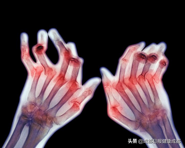 仅两年时间就从腿脚利索变成半残废，这种病要尽早达标治疗才行