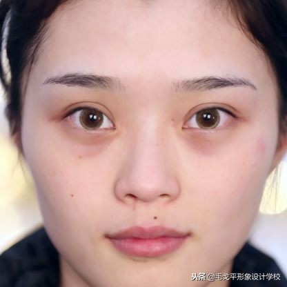 痔疮膏去黑眼圈的正确方法,痔疮膏去黑眼圈最快最好方法