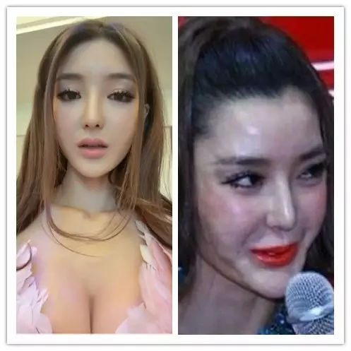 触目惊心的微整形,打菲洛嘉水光针后爆痘