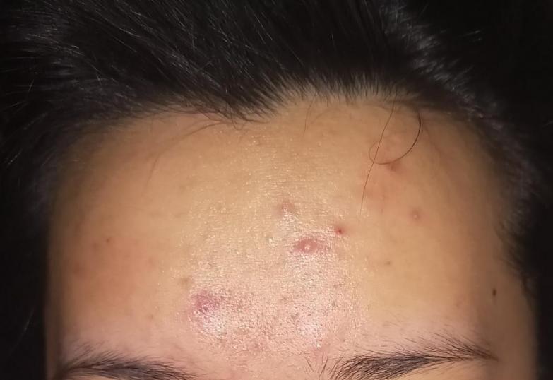 脸上长痘的几种原因,脸上长痘的三种原因