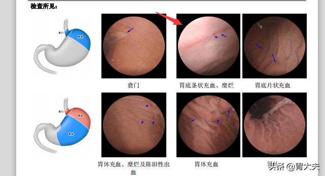 磁控胶囊胃镜需要做心电图吗,30岁可以检查磁控胶囊胃镜吗