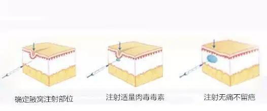 夏天来了如何摆脱烦人的腋臭,夏天腋臭如何消除最快