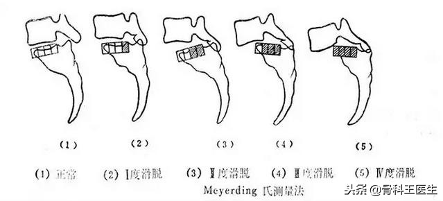 腰椎滑脱可以复位吗,第四腰椎向前滑脱1度可以复位吗