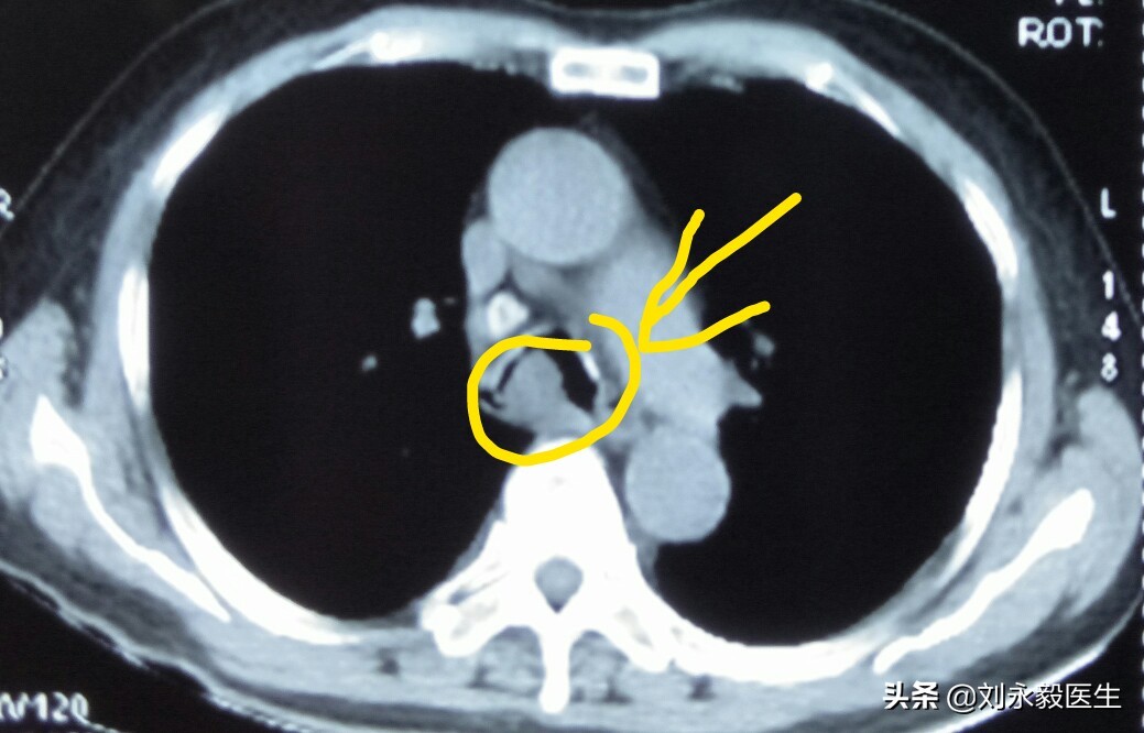 肺癌能治愈吗花多少钱,肺癌能治愈吗中医