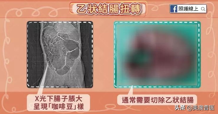 乙状结肠扭转原因,乙状结肠扭转病例