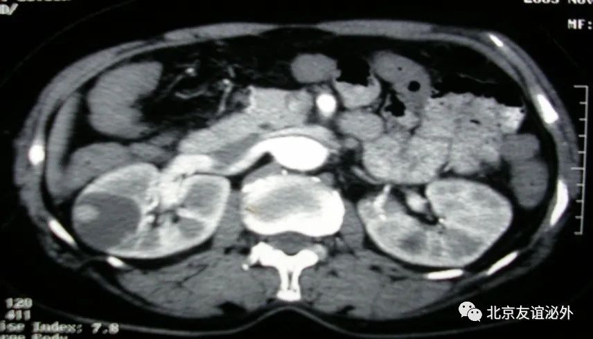 体检发现肾囊肿需不需要做手术,儿童体检发现肾囊肿