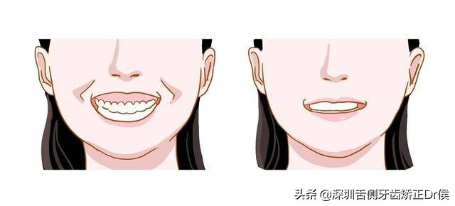 露龈笑怎么办,露龈笑矫正