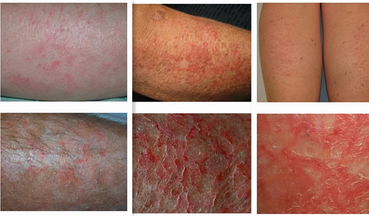 关于皮炎的注意事项有哪些,得了皮炎需要注意什么