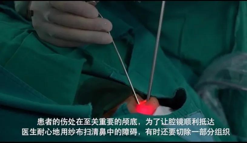 脑子积水手术,脑子漏水的最佳治疗方法