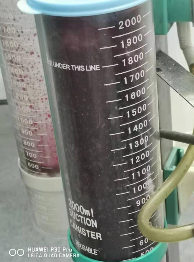 肠破裂出血严重吗,肠破裂会死亡吗