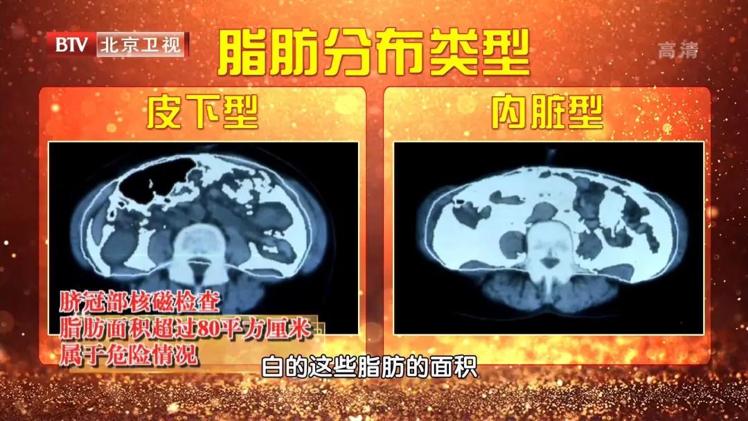 手法调理小肚子肥胖,腹部肥胖是百病之根