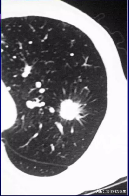 肺结核和肺癌的ct怎么鉴别,肺结核的ct鉴别诊断