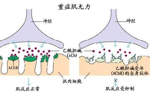 重症肌无力的治疗原则有哪些,重症肌无力饮食怎么调理