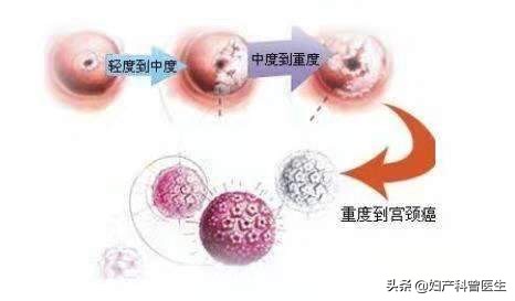 25岁宫颈癌筛查有必要吗,20岁之前得宫颈癌的几率大吗
