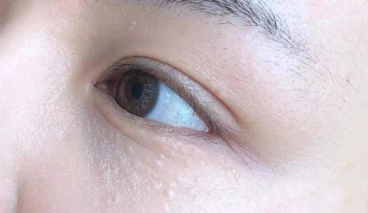 脸上的小疙瘩就是脂肪粒？傻傻分不清楚，又该如何祛除？