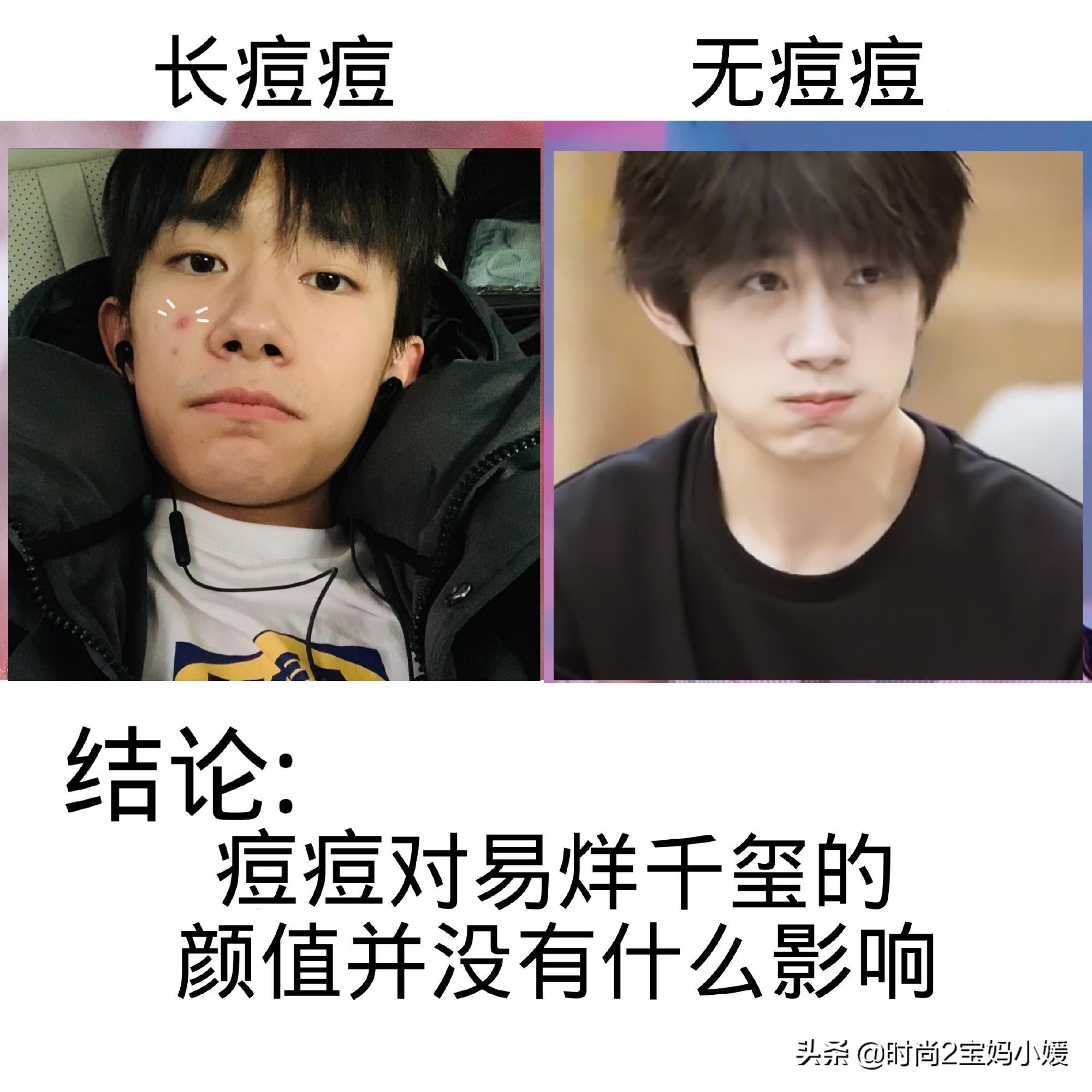 长痘痘不要怕祛痘有良方,长痘痘了该如何消痘不用任何药品