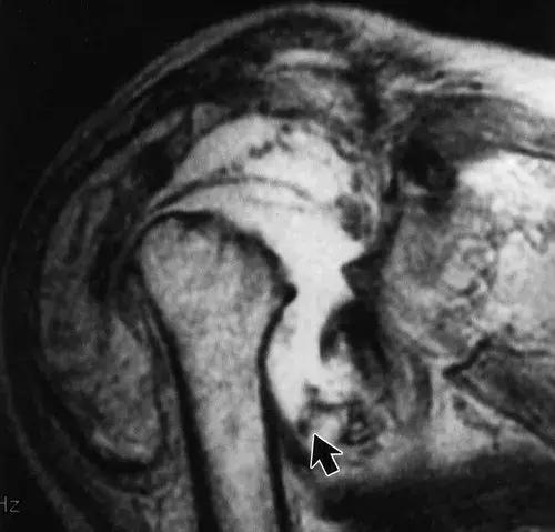 神经性骨关节病,神经性关节炎症状图片