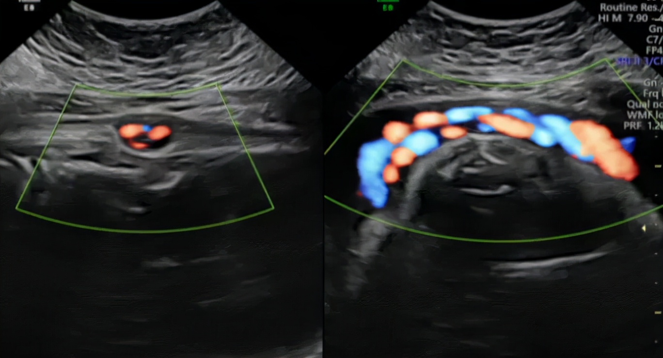 孕妈们胎儿脐带绕颈不要慌,脐带绕颈一般发生在多少周