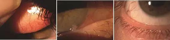 干眼症为什么要查过敏原,怎么判断是过敏还是干眼